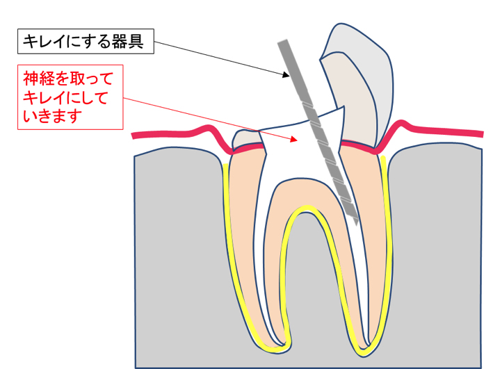 根管治療中の歯の断面図。歯の内部に器具を入れ、神経を除去している様子が示されている。