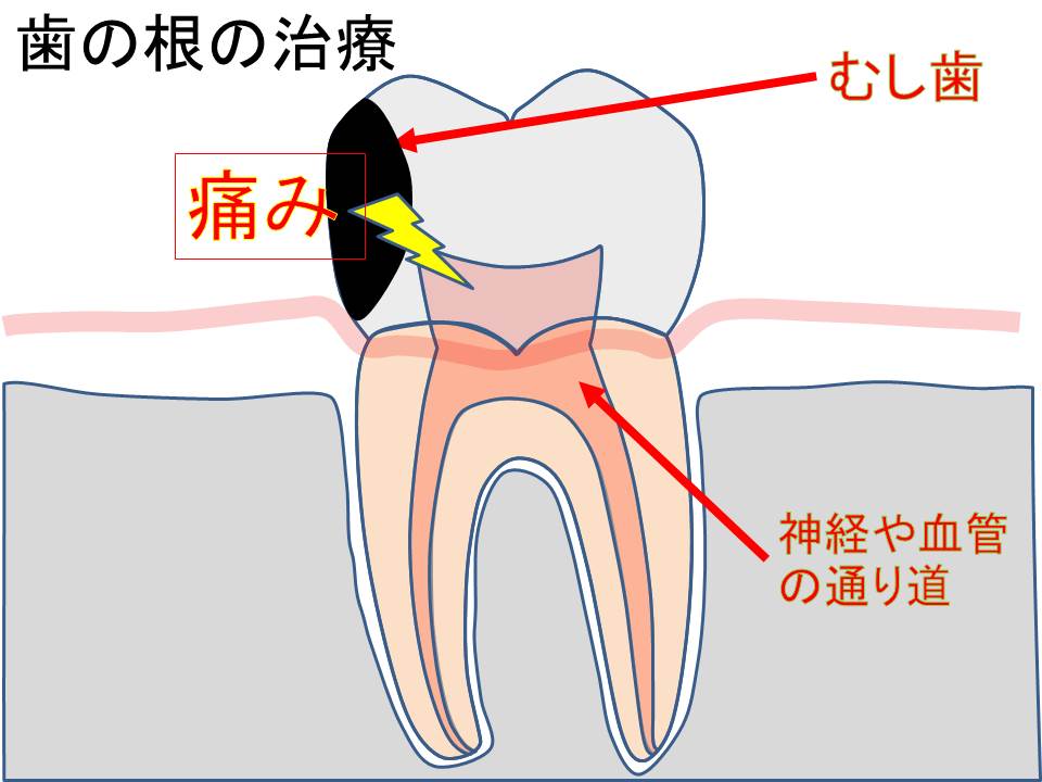 歯の絵_神経の治療
