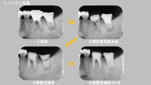 2016.06.14_坂上デンタルオフィス_症例_デンタル経過