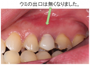 根充時口腔内