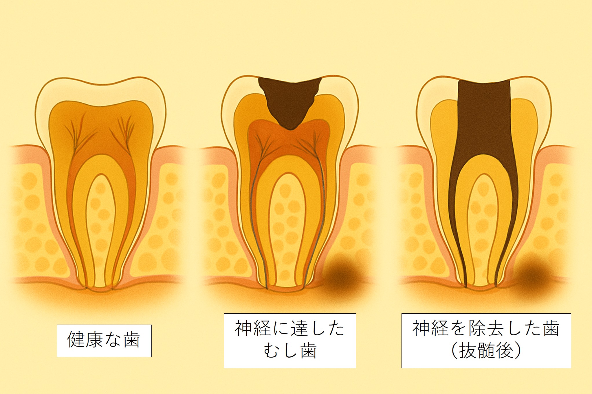 歯の神経の状態の違いを示した断面図。健康な歯、むし歯が神経に達した歯（根尖に黒い影あり）、根管治療を受けた歯の３段階を比較。神経の保存や抜髄、根管治療の必要性を視覚的に説明。