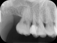歯髄保存処置から6か月後のレントゲン画像。症状は落ち着いており、歯髄が機能を保っていることが確認できる。
