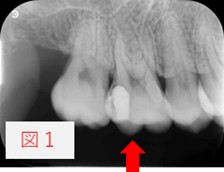 初診時の右上6番のレントゲン画像（図1）。むし歯が神経に非常に近接している歯を赤い矢印で示している。