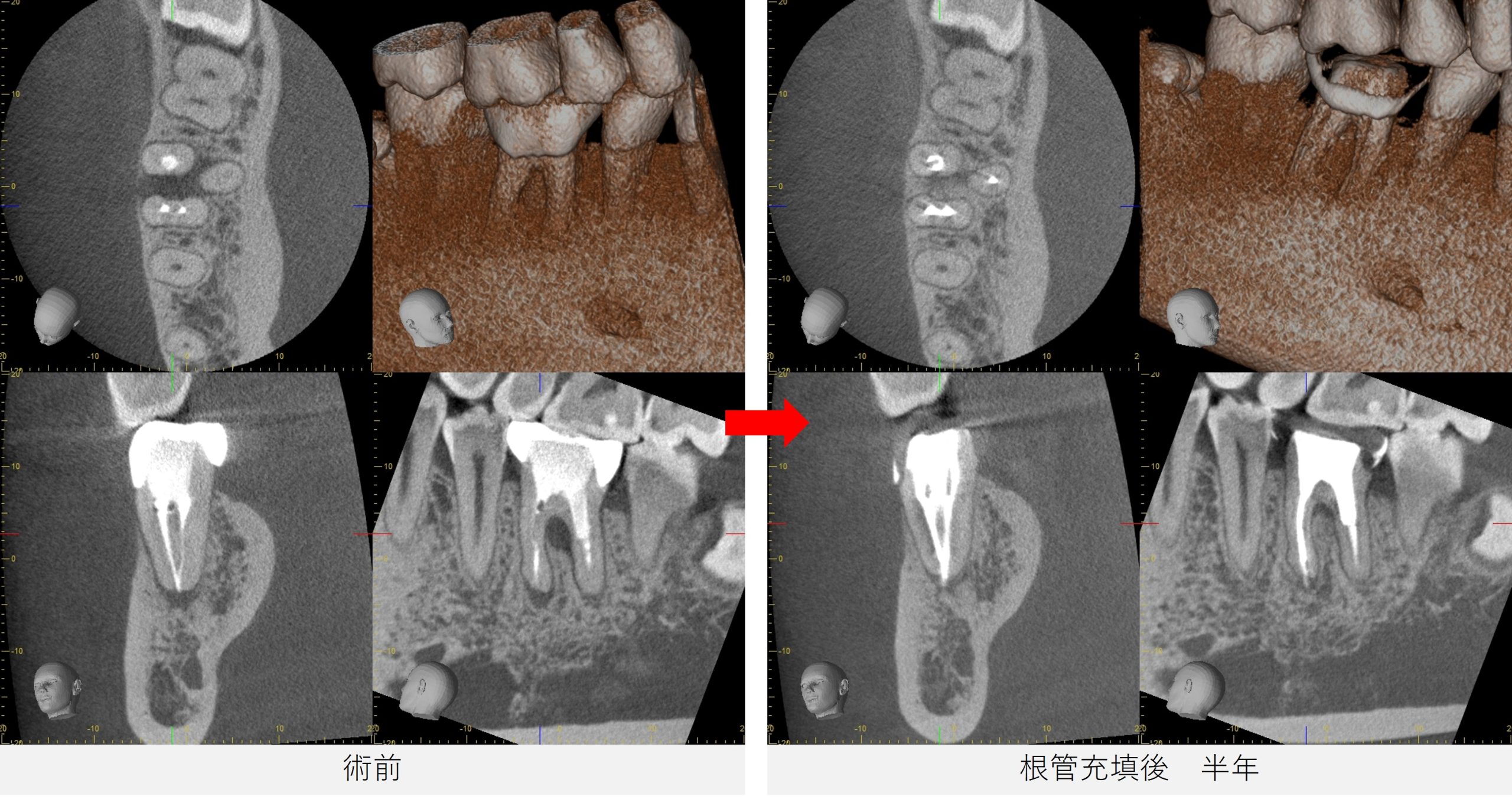 治療前と根管充填後6カ月のCT比較画像。分岐部の黒い影が改善している様子が確認される