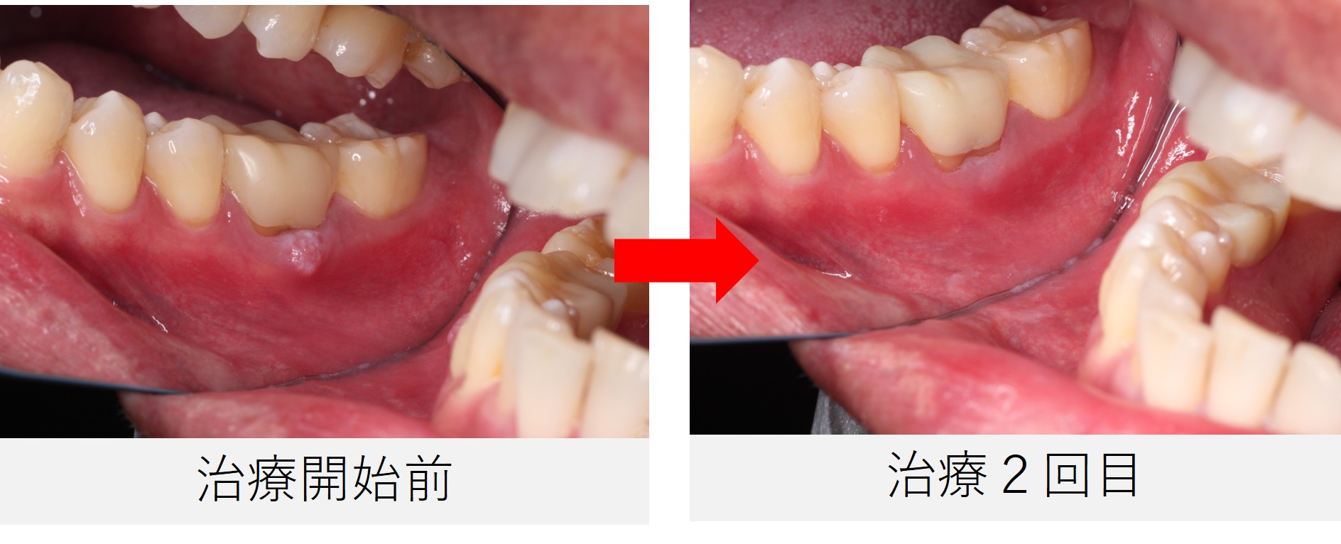 初診時と治療2回目の口腔内比較写真。瘻孔の縮小と歯ぐきの炎症軽減が確認される