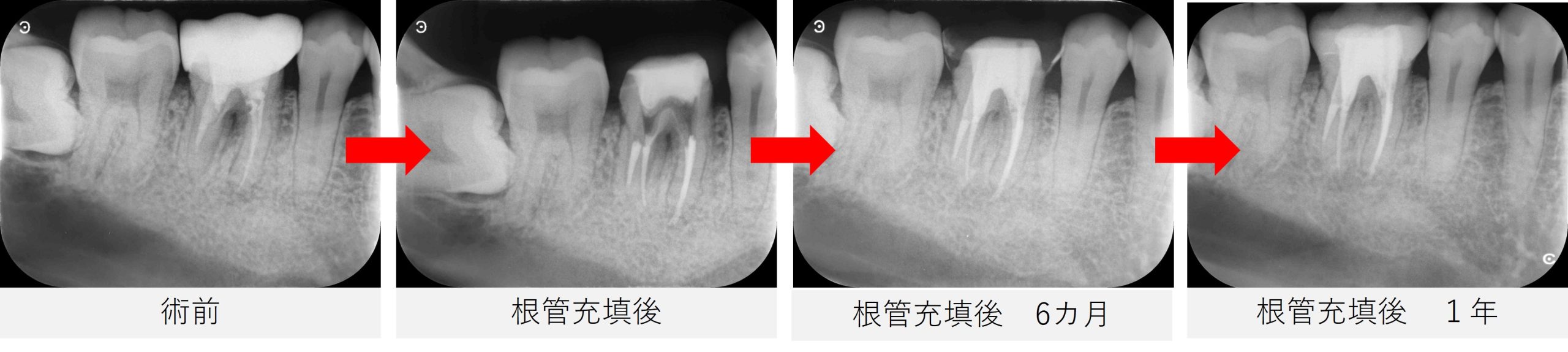 術前・根管充填直後・半年・1年後のレントゲン画像比較。黒い影の改善が時系列で確認できる