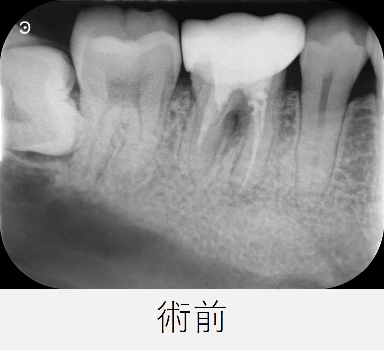 初診時のレントゲン画像。右下6番の根尖部と分岐部に透過像（黒い影）が見られる
