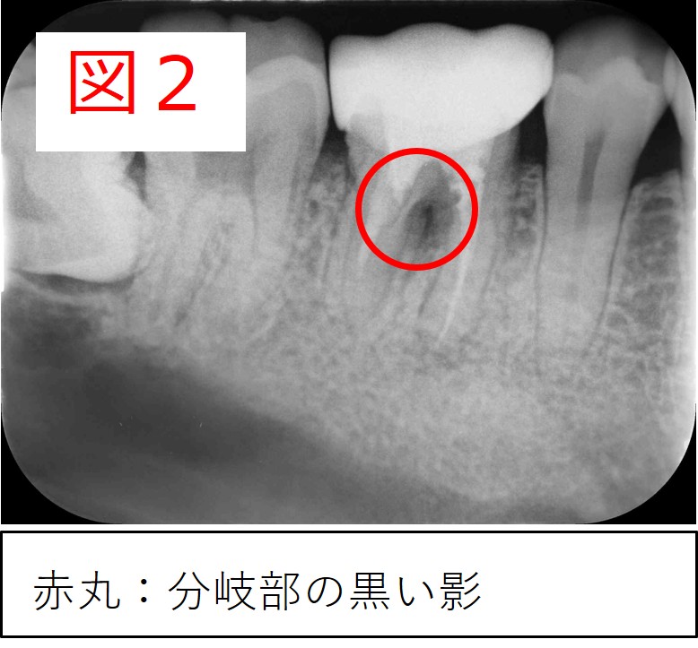 治療前のレントゲンに赤丸で分岐部の黒い影を示した図2