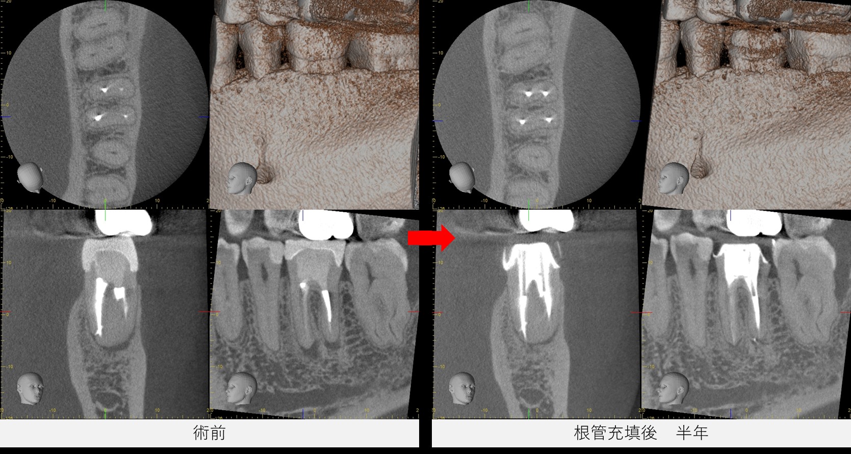 左下6番の術前と根管充填後半年のCT比較画像。根尖の黒い影が改善字ている様子が確認される