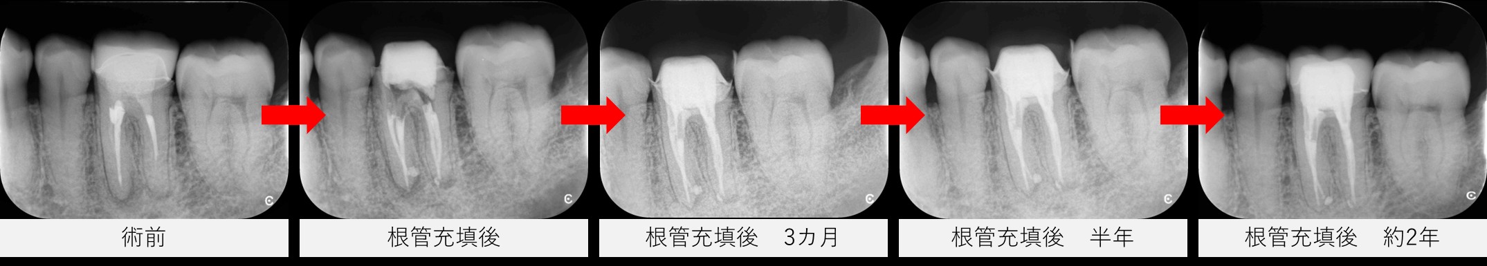 左下6番の術前・根管充填直後・3カ月・半年・2年後のレントゲン画像比較。黒い影の改善が時系列で確認できる
