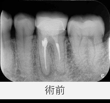 初診時に撮影されたレントゲン画像、左下6番の根尖の黒い影が確認できる