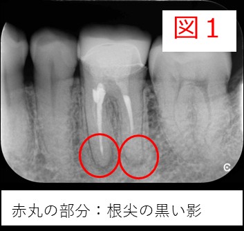 初診時のレントゲン画像（図１：根尖の黒い影を赤丸で示したもの）