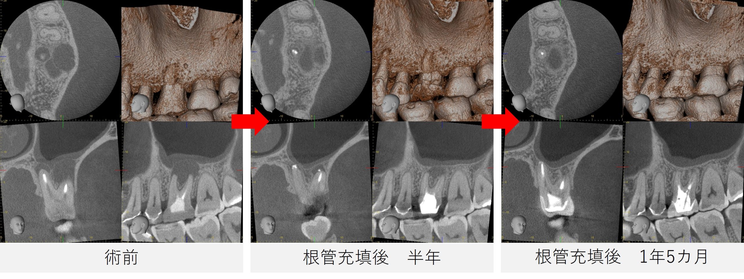 左上６番の術前・根管充填後半年・1年5カ月後のCT画像による経過比較。根尖の黒い影や上顎洞粘膜の改善が確認できる