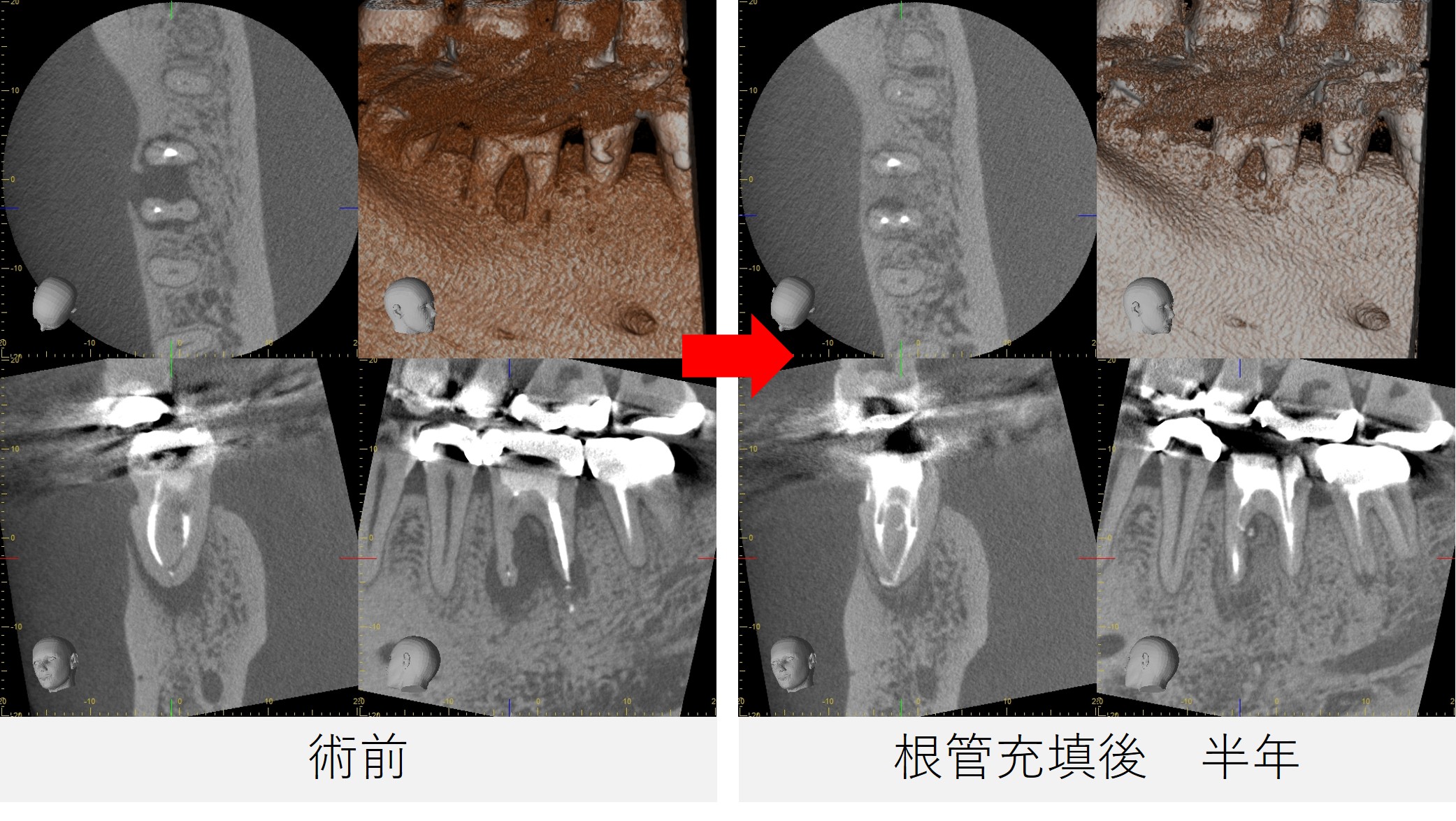 右下６番の術前・根管充填後半年後のCT画像による経過比較