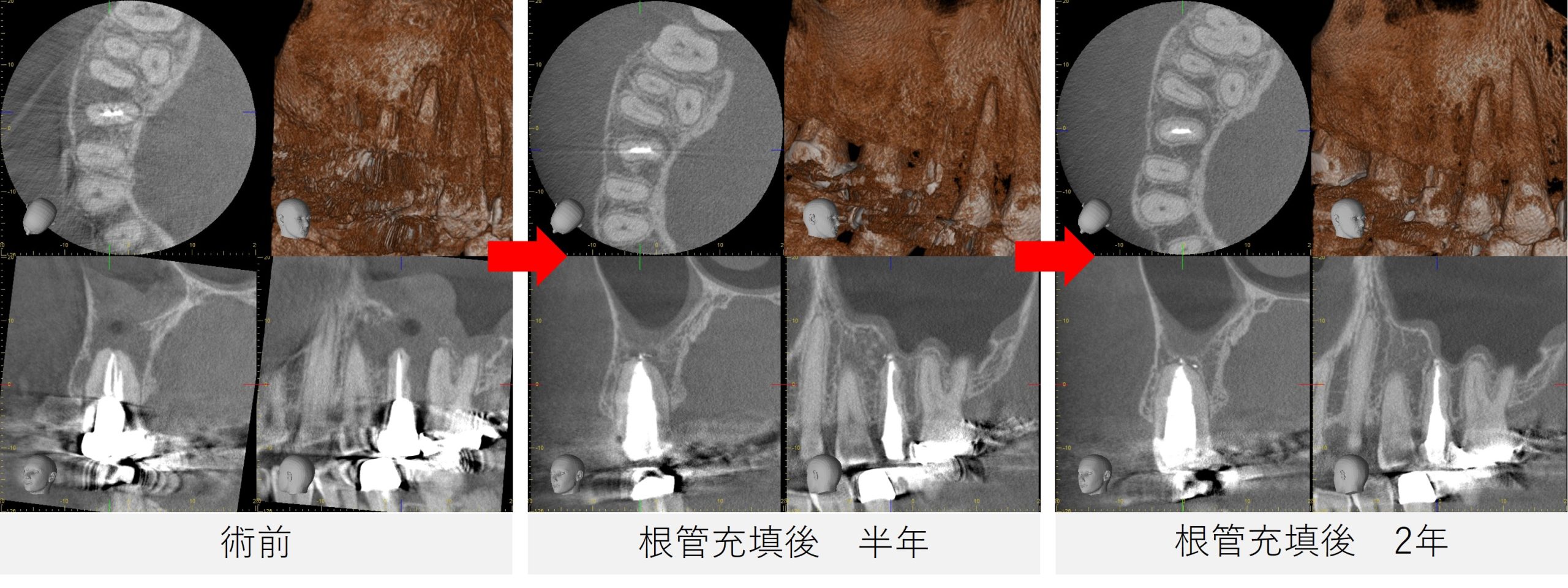 右上5番の術前・根管充填後半年・約2年後のCT画像による経過比較。根尖の黒い影や上顎洞粘膜の改善が確認できる