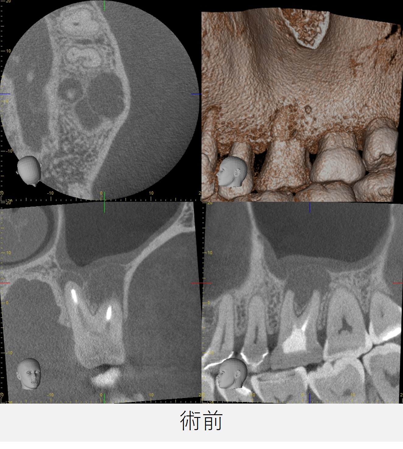 左上6番の初診時のCT画像。3本の根の先に黒い影が見られ、上顎洞粘膜にも影響が及んでいる様子が確認される