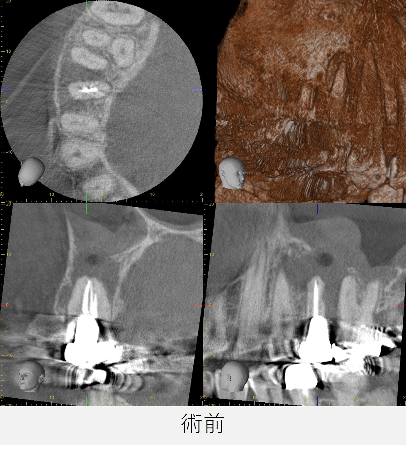 右上5番の初診時のCT画像。銀歯の根の先に黒い影が広がり、上顎洞粘膜の肥厚が確認される