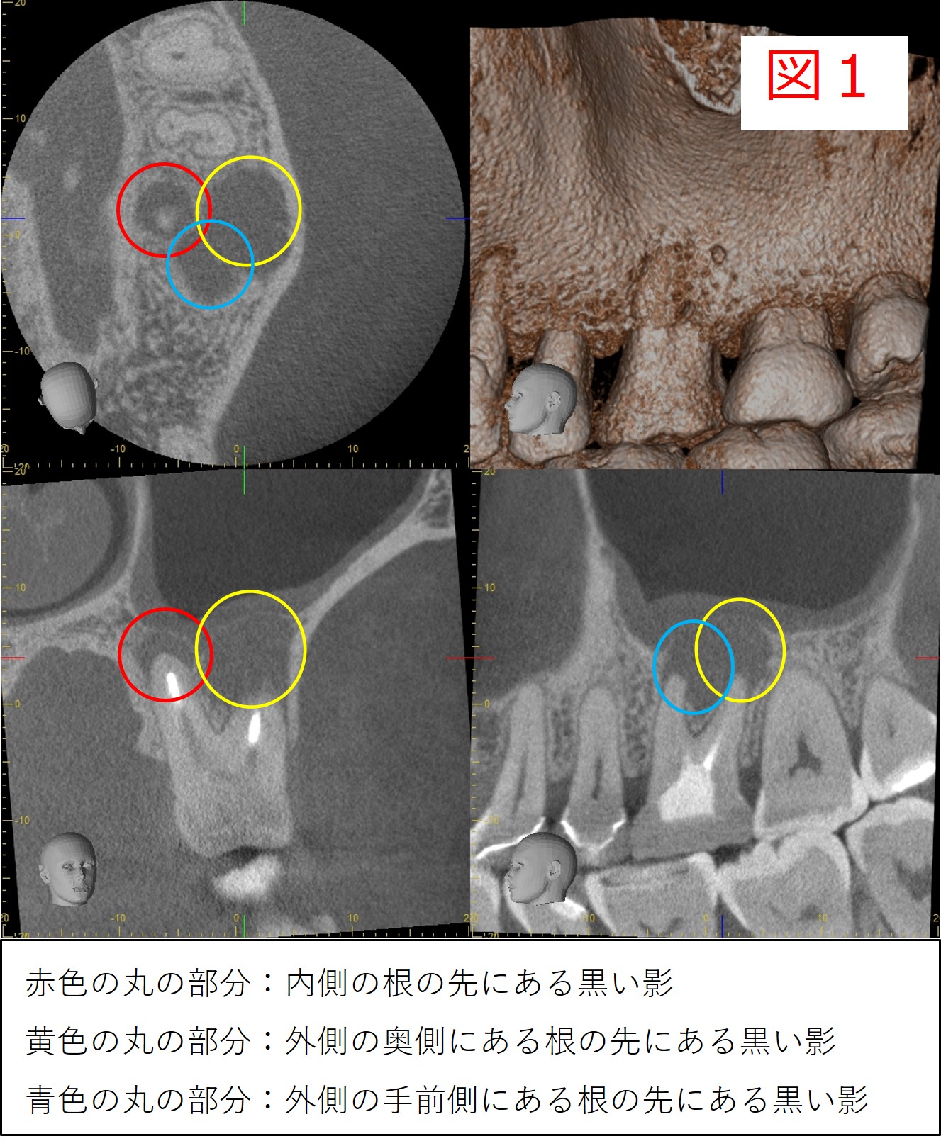初診時のCT画像（図１：3本の根の先に黒い影が見られ、赤・黄・青の丸で示されている。炎症の広がりを視覚的に表現した図）