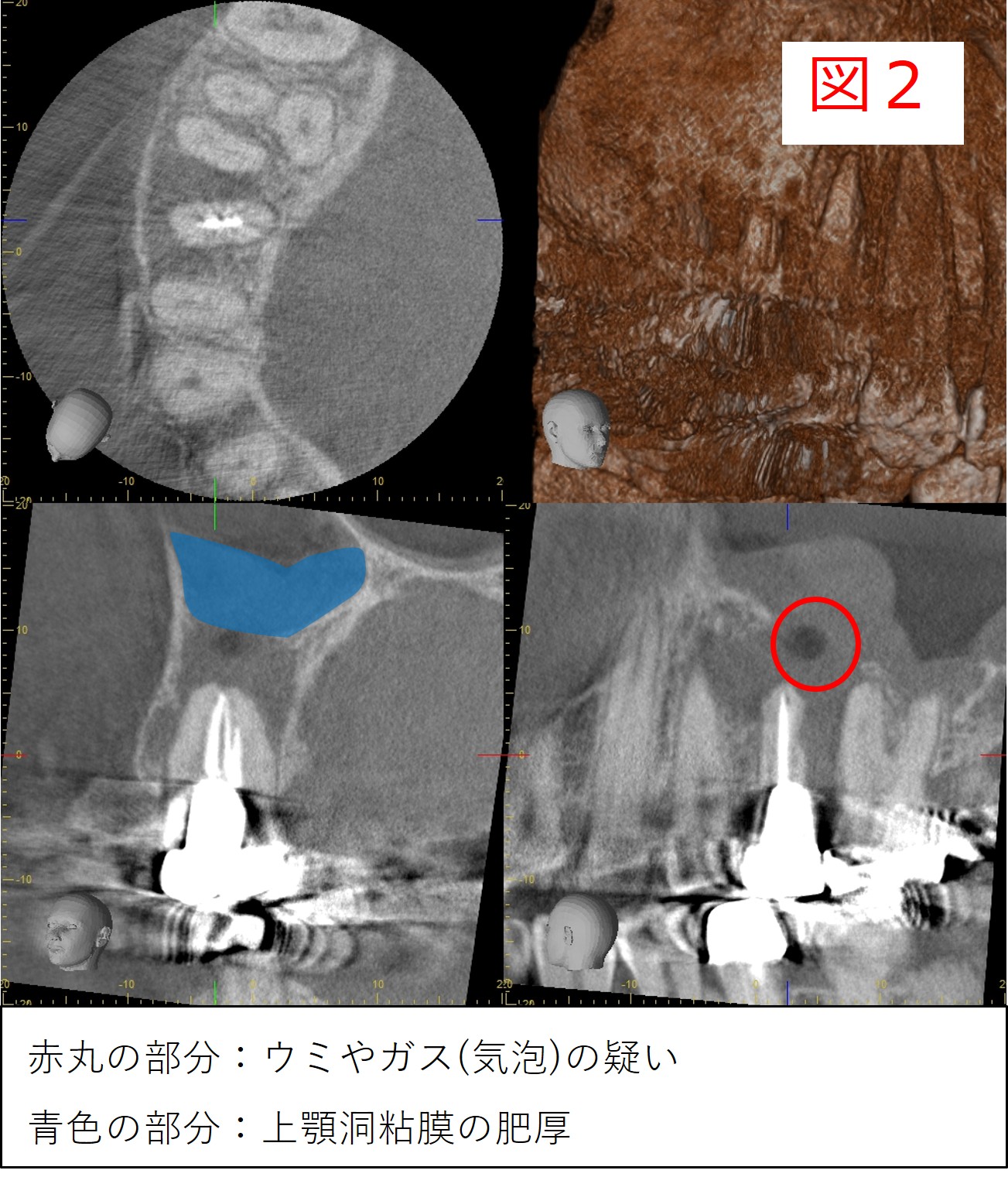 初診時のCT画像（図2：左下の画像では上顎洞粘膜の肥厚を青色で示し、右下の画像ではウミやガス（気泡）が疑われる状態を赤丸で示し、視覚的に表現した図）