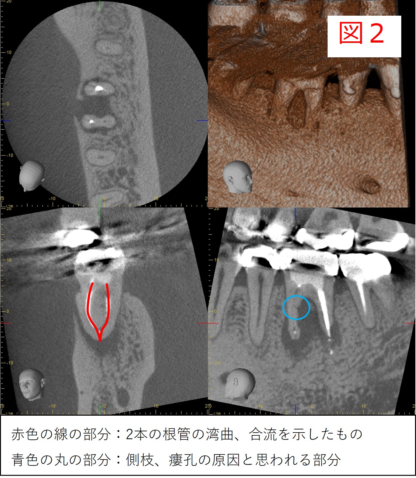 初診時のCT画像（図２：根管が湾曲し根尖で合流している様子、分岐部付近に側枝が確認できる）