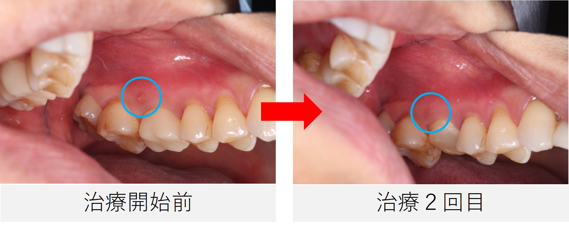 治療前と2回目治療時の口腔内比較写真。歯ぐきにあった瘻孔が消失している様子が確認できる