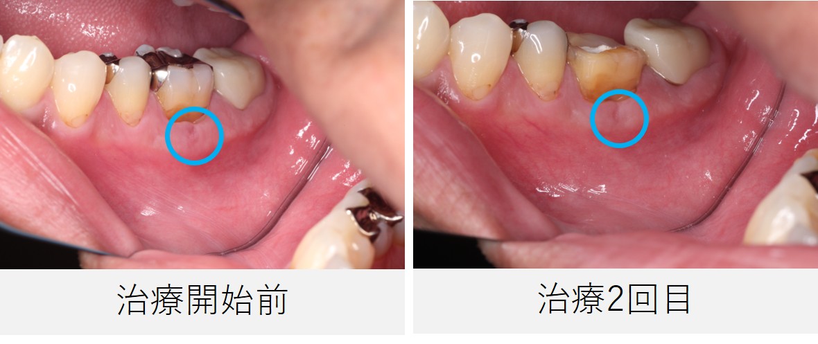根管治療前と治療2回目の口腔内写真。瘻孔の痕が徐々に落ち着いてきている様子が確認できる