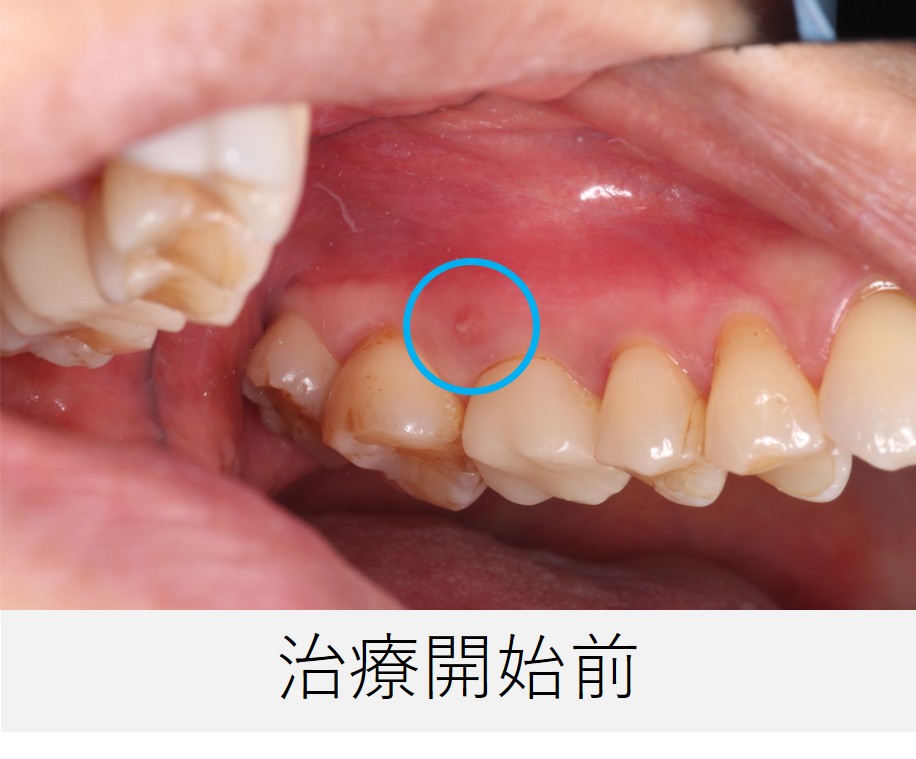 左上６番の治療前の口腔内写真。歯ぐきに小さな瘻孔（ウミの出口）が確認される