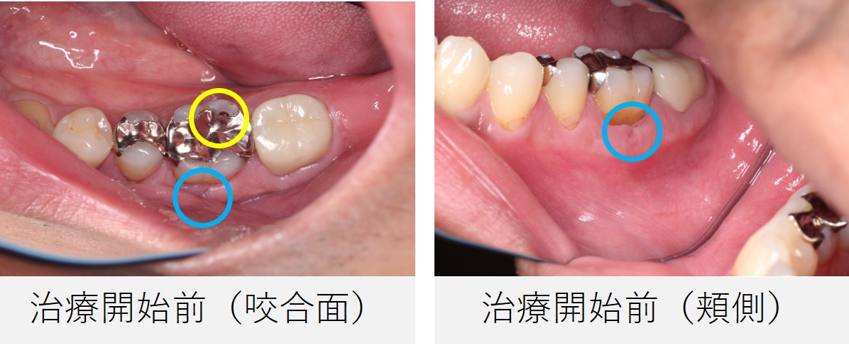 右下6番の治療前の口腔内写真。不適合な銀歯が装着され、歯と歯ぐきの境目に瘻孔の痕がみられる