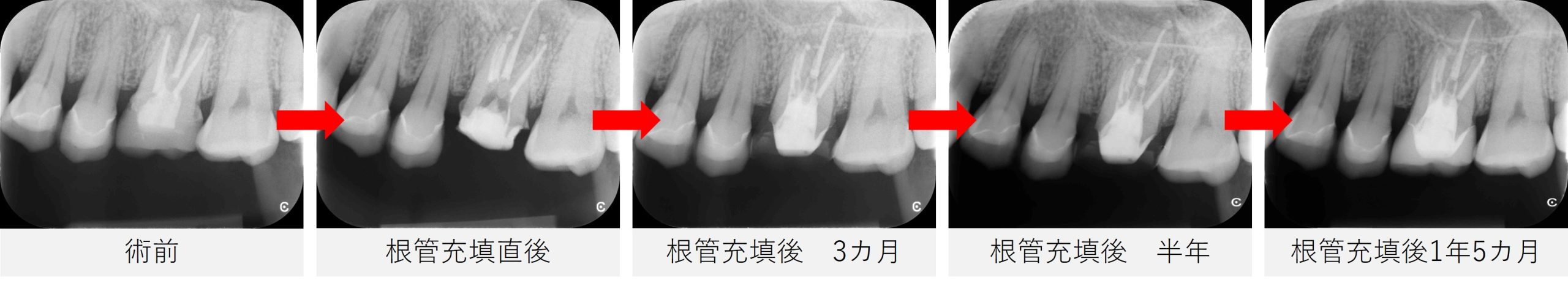 左上６番の術前・根管充填直後・3カ月・半年・1年5カ月後のレントゲン画像比較。根の先の黒い影が徐々に縮小・改善していく様子を確認できる