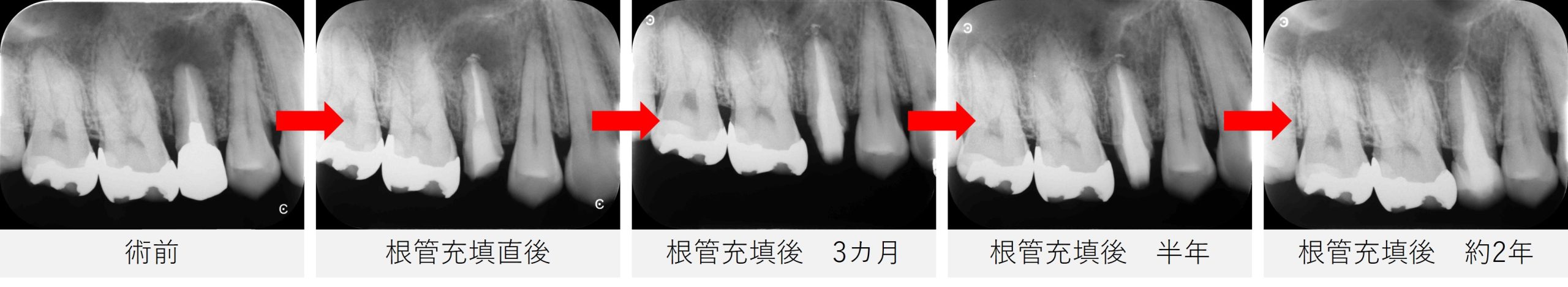 右上5番の術前・根管充填直後・3か月・半年・約2年後のレントゲン画像比較。根の先の黒い影が徐々に縮小・改善していく様子を確認できる