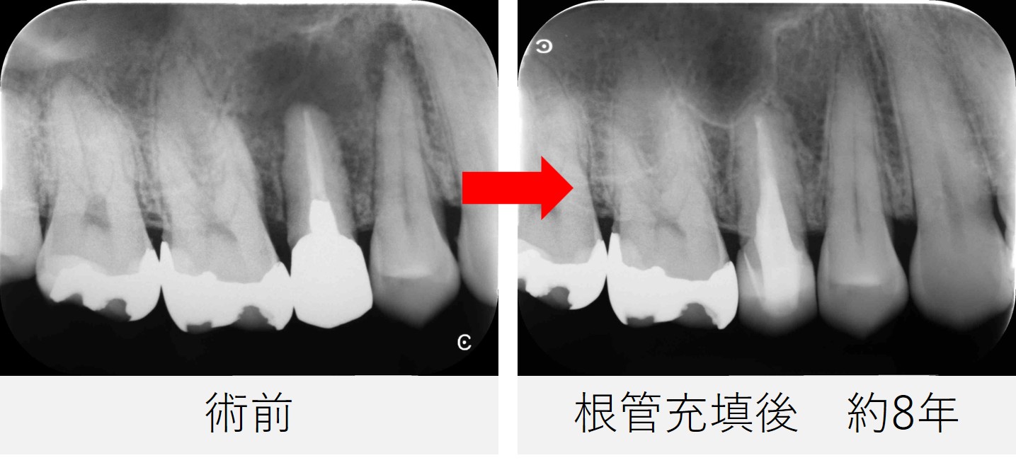 術前と根管充填から約8年後のレントゲン画像比較。根尖の黒い影の改善が確認できる