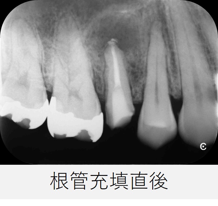 右上5番の根管充填直後のレントゲン画像。根の先からわずかに根充材が逸出しているが、根管充填は良好と判断