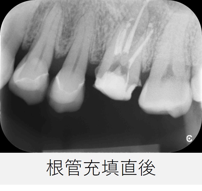 左上６番の根管充填直後のレントゲン画像。根の先からわずかに根充材が逸出しているが、根管充填は良好と判断