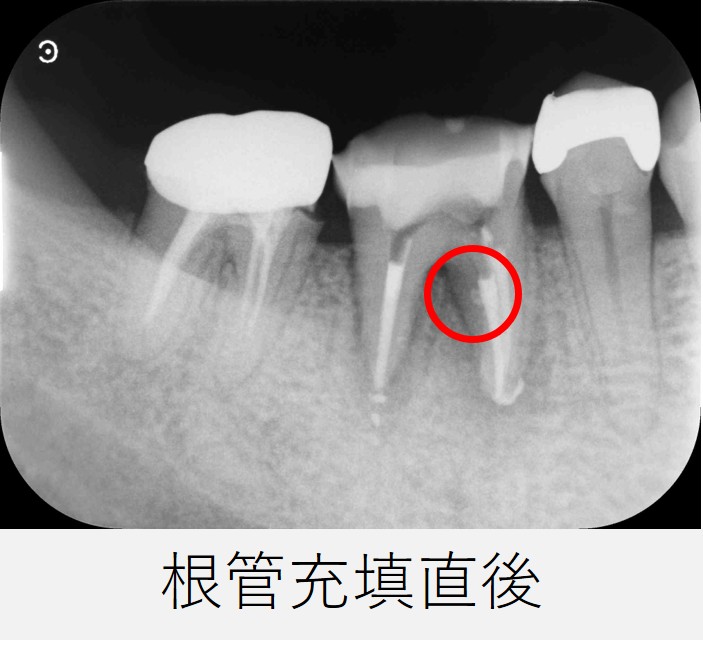 右下６番の根管充填直後のレントゲン画像。側枝にまで充填材が到達した可能性を示す像が確認できる