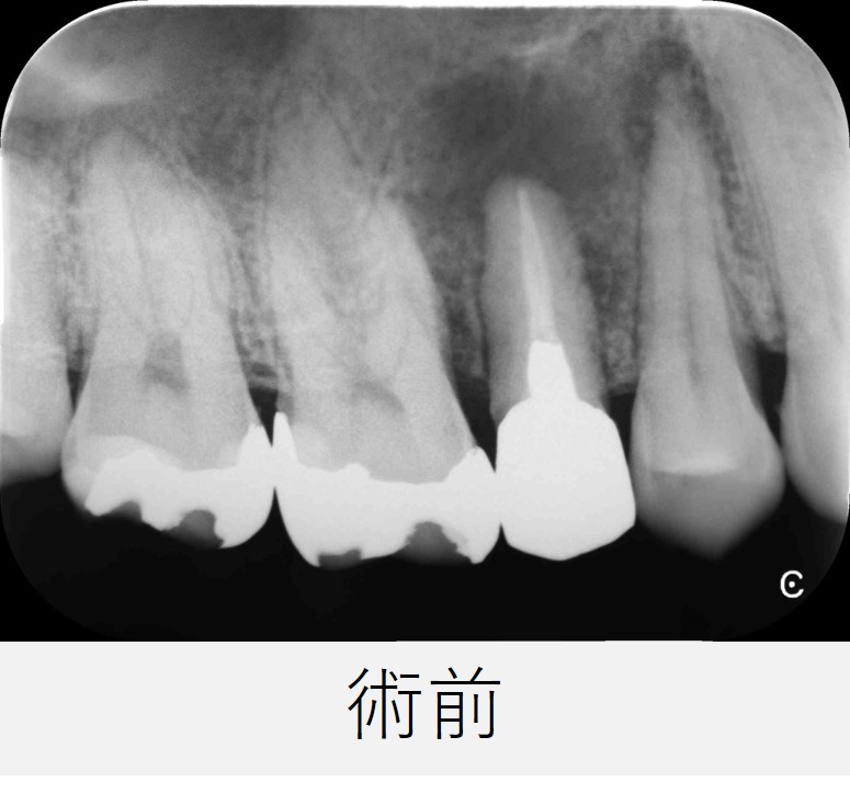 右上5番の初診時のレントゲン画像。歯の根の先に黒い影が大きく広がっており、骨がなくなっている様子が確認できる