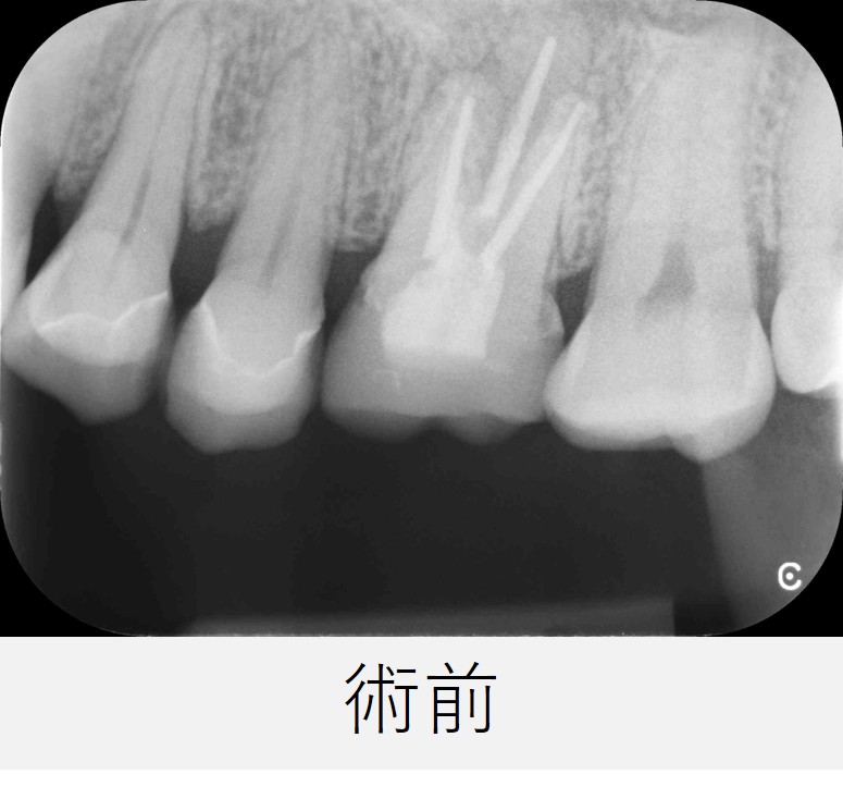 左上６番の初診時のレントゲン画像。すでに根管治療が行われているが、歯の根の先に黒い影が確認される