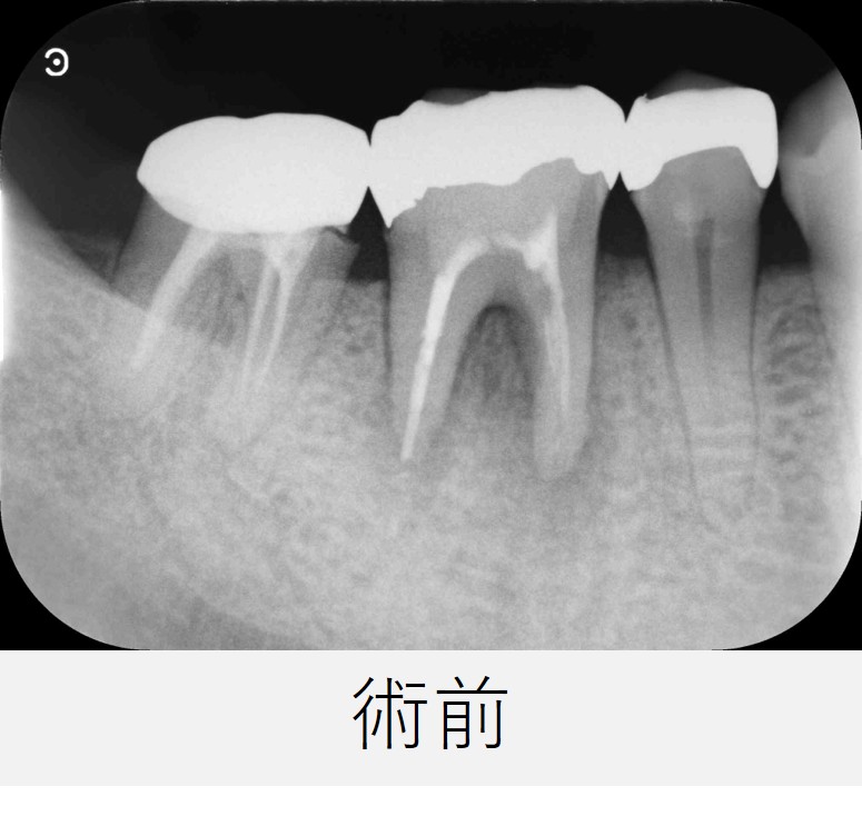 右下6番の初診時のレントゲン画像。すでに根管治療が行われているが、歯の根の先と根の分かれている部分に黒い影が確認される