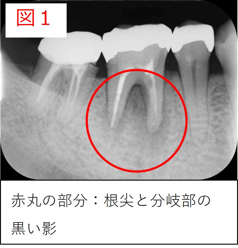初診時のレントゲン画像（図１：根尖と分岐部に黒い影が見られる）