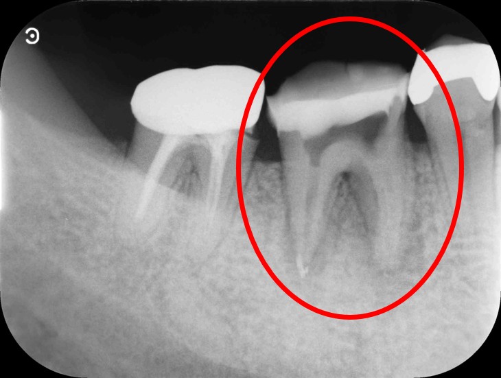 根管治療中のレントゲン画像。過去の根管充填材が除去されているかを確認する目的で撮影されたもの