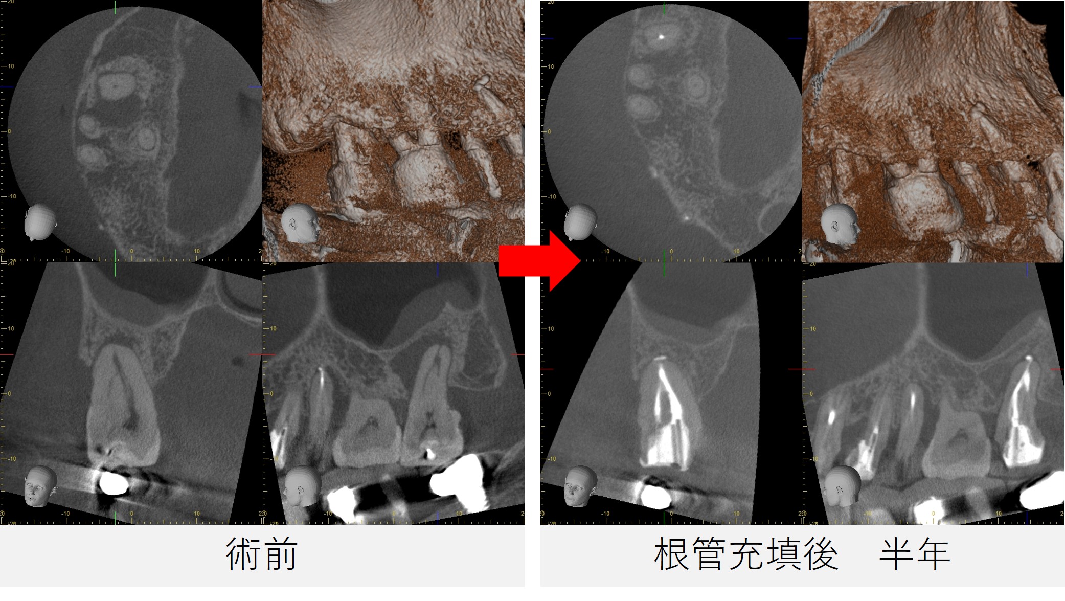 治療前と根管充填後6カ月のCT比較画像。治療前には根尖部に骨欠損が認められたが、6カ月後の画像では骨の再生が確認でき、経過は良好。