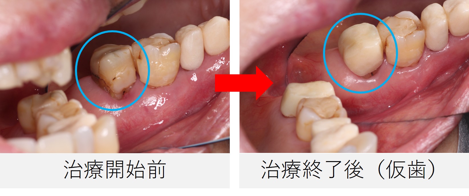 治療前と治療終了後（仮歯装着時）の口腔内写真。治療部位には仮歯が装着され、形態と機能が回復している様子が確認できる。