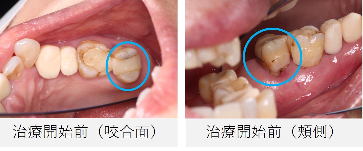 治療開始前の奥歯の状態を示す2枚の口腔内写真。左は咬合面から、右は頬側からの撮影で、むし歯や詰め物の段差がある歯を青丸で強調。