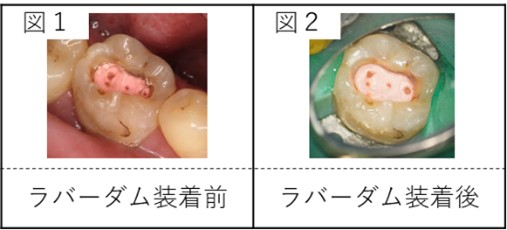 ラバーダム装着前（図1）と装着後（図2）の比較写真。装着により唾液の侵入を防ぎ、清潔な環境で治療が行えることが示されている