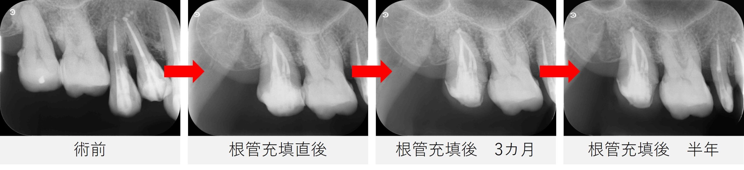 右上７番の術前・根管充填直後・3カ月・半年後までの経過を示すレントゲン画像。根尖部の骨の治癒過程と経過の安定が確認できる。