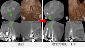 右上4番のCT画像比較。術前には根尖から口蓋側に広がる黒い影が見られたが、根管充填から1年後には骨の再生が進み、改善傾向が確認できる