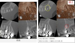 右上4番の初診時CT画像。赤い線は根管の側枝を示し、黄色い丸は口蓋側に広がる黒い影を示している（図２）。