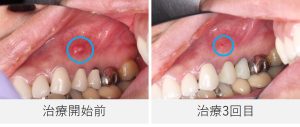 治療前と治療3回目の口腔内写真比較。治療前には右上小臼歯の歯ぐきに瘻孔が見られたが、治療後には改善し、赤みのある小さな痕が残るのみとなっている。