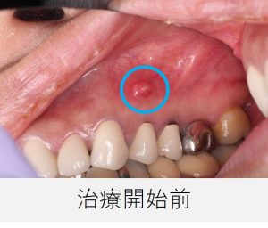 治療開始前の口腔内写真。右上小臼歯の歯ぐきに赤いウミの出口（瘻孔＝フィステル）が確認できる