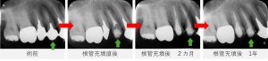 右上4番の術前・根管充填直後・2カ月後・1年後までの経過を示すレントゲン画像。術前には根尖部に黒い影が見られたが、黒い影が改善している様子が確認できる。