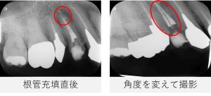 右上4番の根管充填直後のレントゲン画像2枚。根尖と側枝まで充填材が行き届いており、角度を変えて撮影することで2本の根管に薬剤が適切に入っている様子が確認できる。